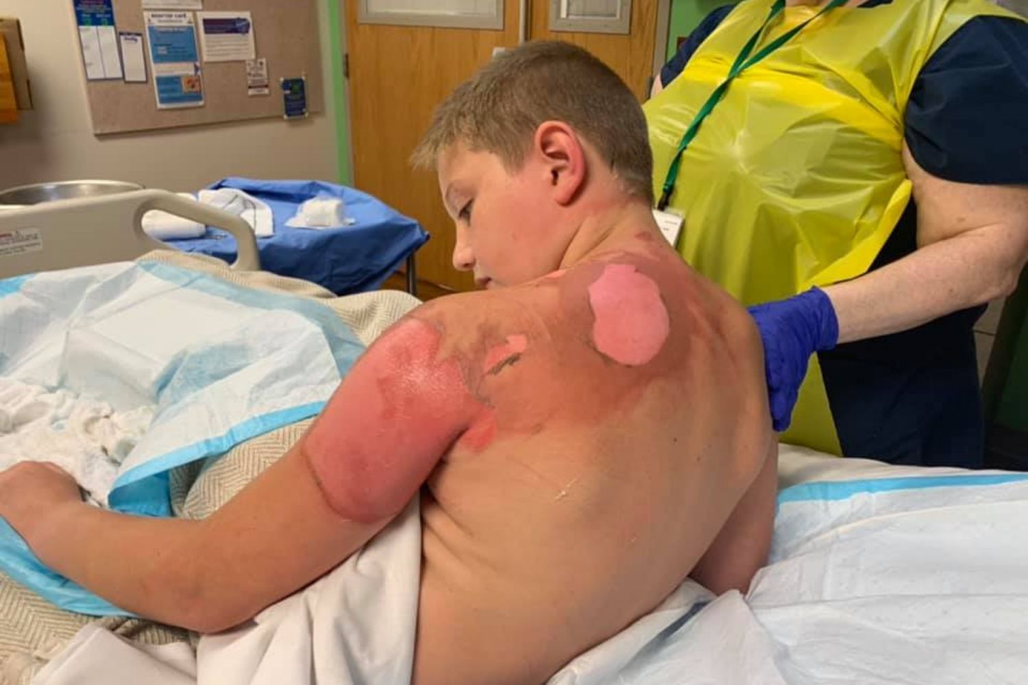 An 11-year-old boy has suffered third degree burns when boiling water was f...