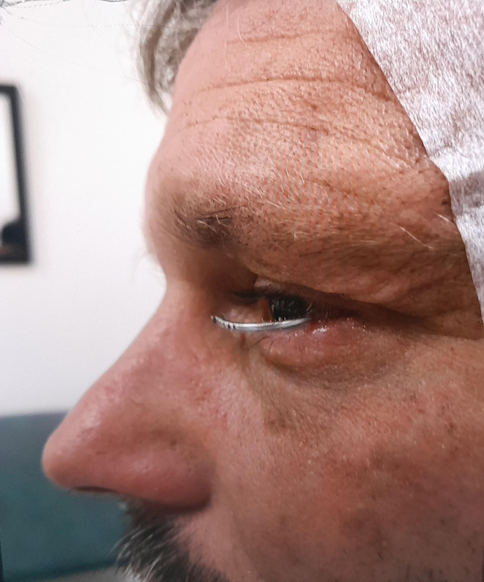Image of side profile of man with nail sticking out from lower left eye