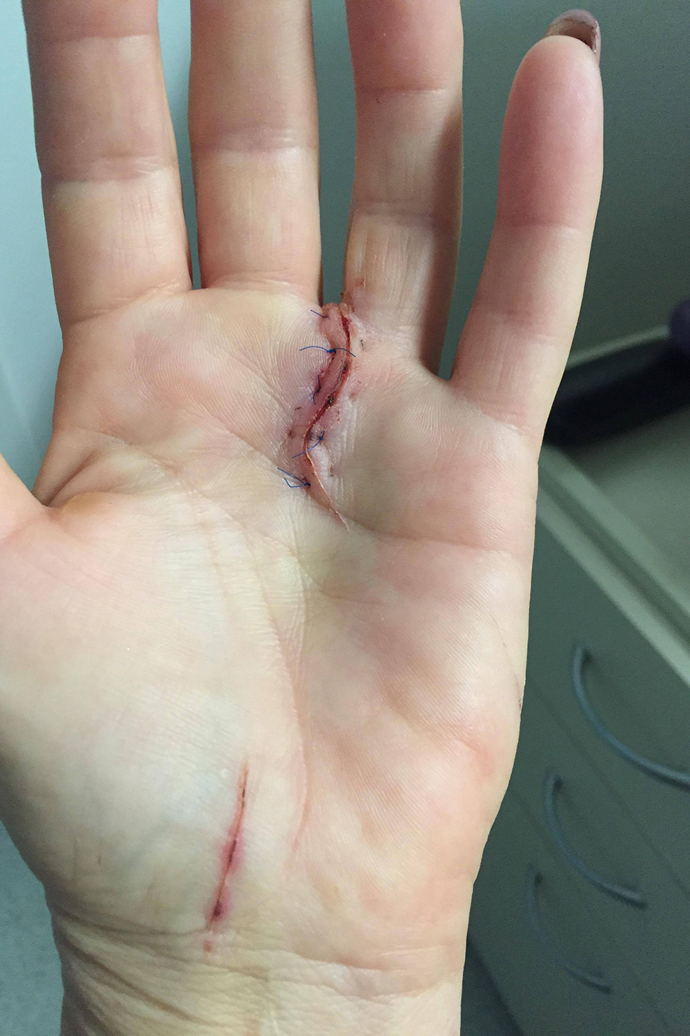 I had defence wounds