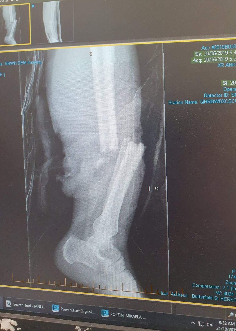 Mikaela Holzheimer hospital scans